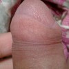 包皮过长的自我检测措施