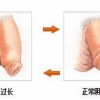 全面认识包皮过长的危害性
