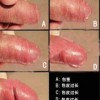 为什么男性会出现包皮过长