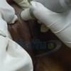 外阴白斑的饮食护理有哪些