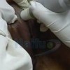 青岛外阴白斑的治疗哪种措施好