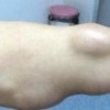 结肠脂肪瘤有什么辅助检查措施
