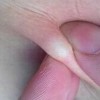 怎样有效预防脂肪瘤呢