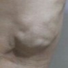 该怎样预防乳腺脂肪瘤呢