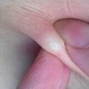 生活中应该怎样的预防乳房脂肪瘤