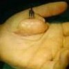 怎样预防脂肪瘤