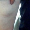 乳腺脂肪瘤的病因有什么呢