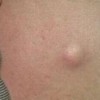 引起乳腺脂肪瘤的病因有什么