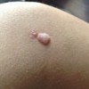 乳房脂肪瘤的临床症状有哪些