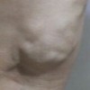 乳腺脂肪瘤的症状有哪些呢
