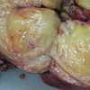 乳腺脂肪瘤手术治愈效果好吗