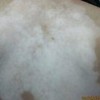 冬季怎样预防白癜风