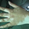 青少年白癜风的症状是什么样的