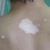 发展期白癜风具有什么症状特点