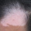 秋季孕妇得了白癜风都症状有什么