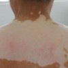 白癜风患者可以使用香水吗