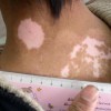 白癜风养生八宜