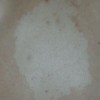 白癜风初期病情有哪些