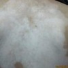 白癜风为何难治
