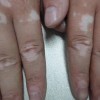 白癜风病人肌肤干燥该怎么办