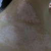 白癜风都能扩散全身吗