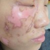 爸爸得了白癜风会遗传给孩子吗