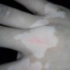 白癜风想要孩子怎么减少遗传