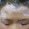 白癜风容易在哪类人群中高发