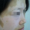 白癜风到底是一种什么病