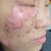 白癜风好的诊疗方案是什么