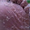 脚气的图片是什么样子的