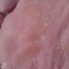 脚气的症状图片有哪些
