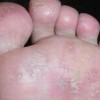 脚气产生的病因有什么