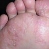 脚气有哪些常见症状