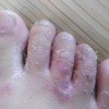 脚气有什么常见症状