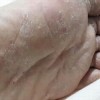 春夏为什么易患脚气的季节