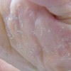 青岛脚气要如何治疗