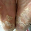 青岛脚气怎么治疗
