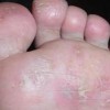 青岛脚气脚臭如何治疗