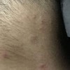 性病都有哪些表现 性病症状有什么