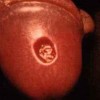 辽宁专家详解性病淋巴肉芽肿症状