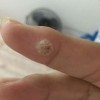 青岛皮肤病寻常疣治疗