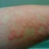 丘疹性荨麻疹的五点护理措施