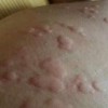 荨麻疹的饮食注意什么事情