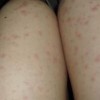 需知的荨麻疹的危害