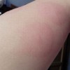 青岛丘疹性荨麻疹怎样治疗呢