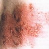 腰部疱疹的症状图片