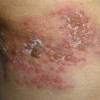 带状疱疹是由于什么因素致使