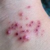 春季皮肤痒痛需警惕带状疱疹