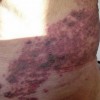 生化筋络阻滞疗法治疗带状疱疹
